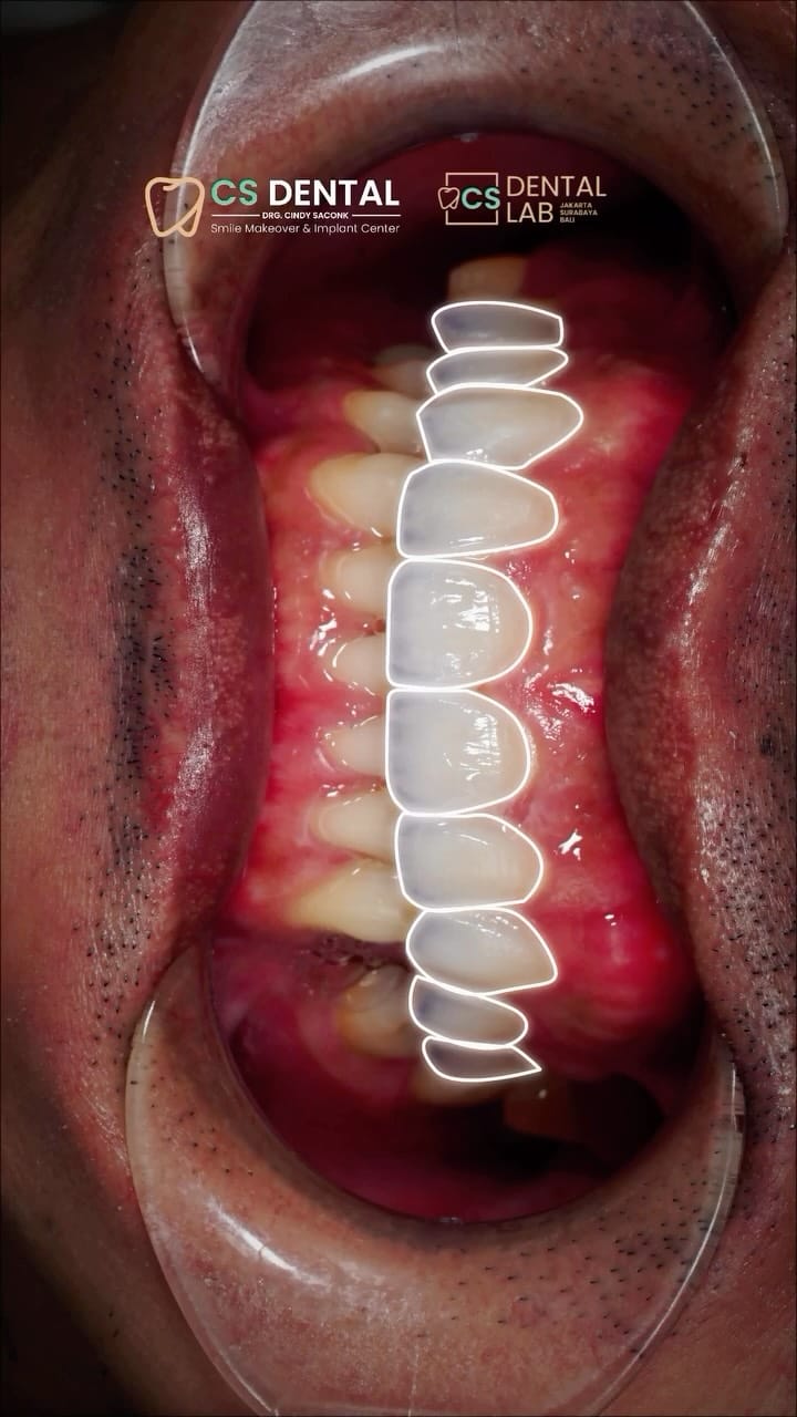 Post 4 by KLINIK GIGI • DOKTER GIGI • CS DENTAL LAB JAKARTA on Instagram (video)