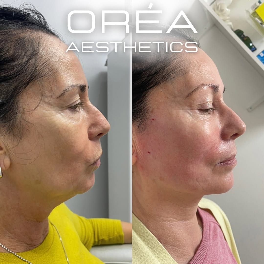 Post 1 by Aesthetics Experts - London, Herts & Oxon on Instagram (carousel)