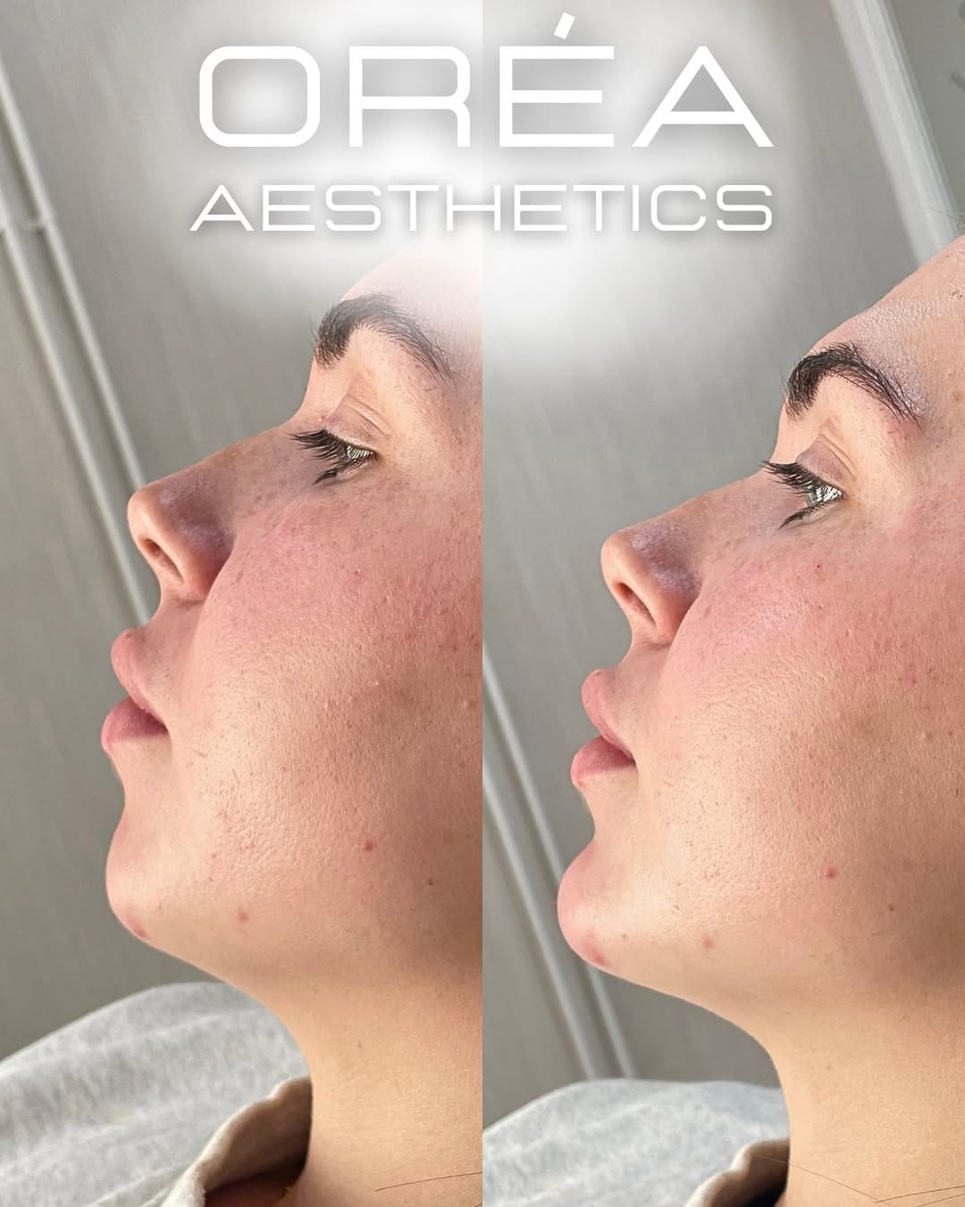 Post 6 by Aesthetics Experts - London, Herts & Oxon on Instagram (image)