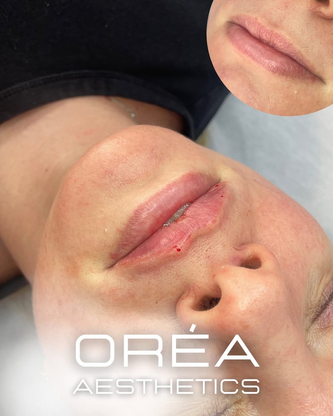 Post 7 by Aesthetics Experts - London, Herts & Oxon on Instagram (image)
