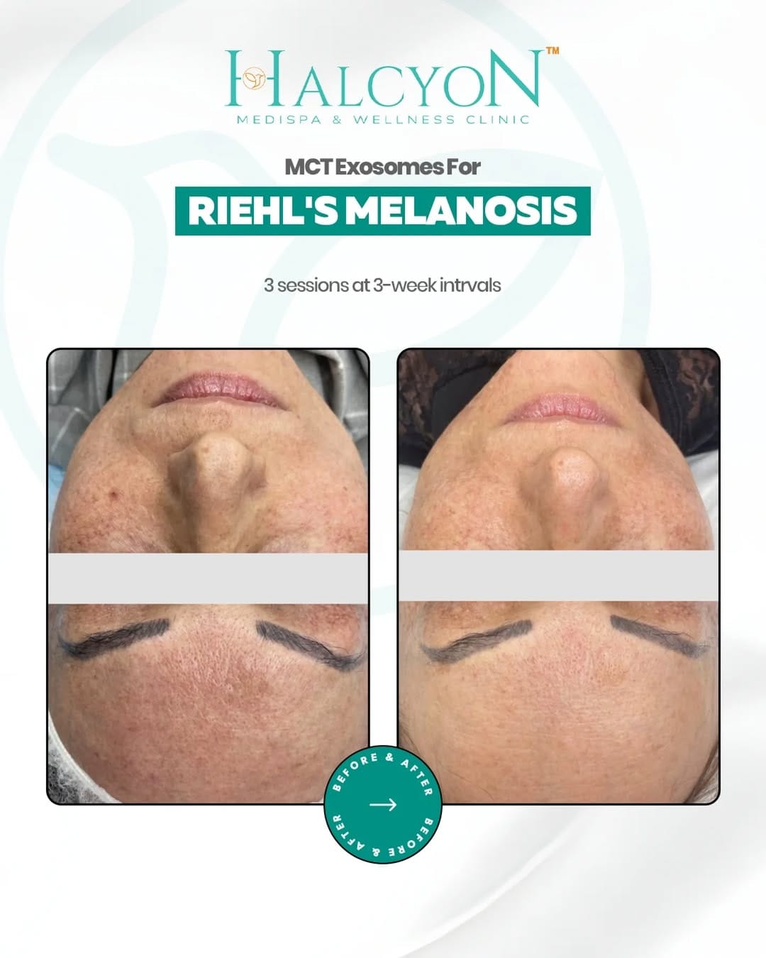 Post 8 by Halcyon Medispa & Wellness Clinic ™ on Instagram (image)