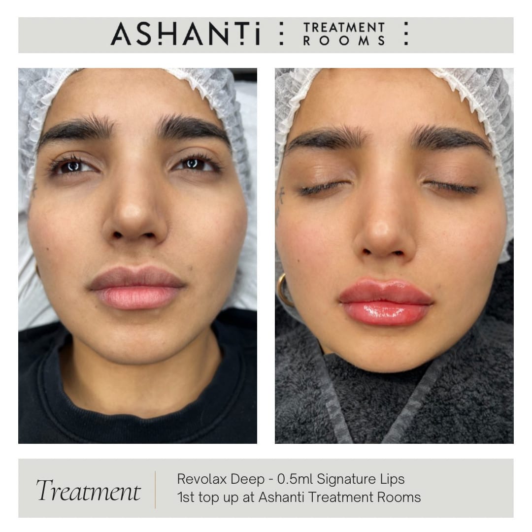 Post 4 by Ashanti Aesthetic Beauty Treatment Rooms London on Instagram (image)