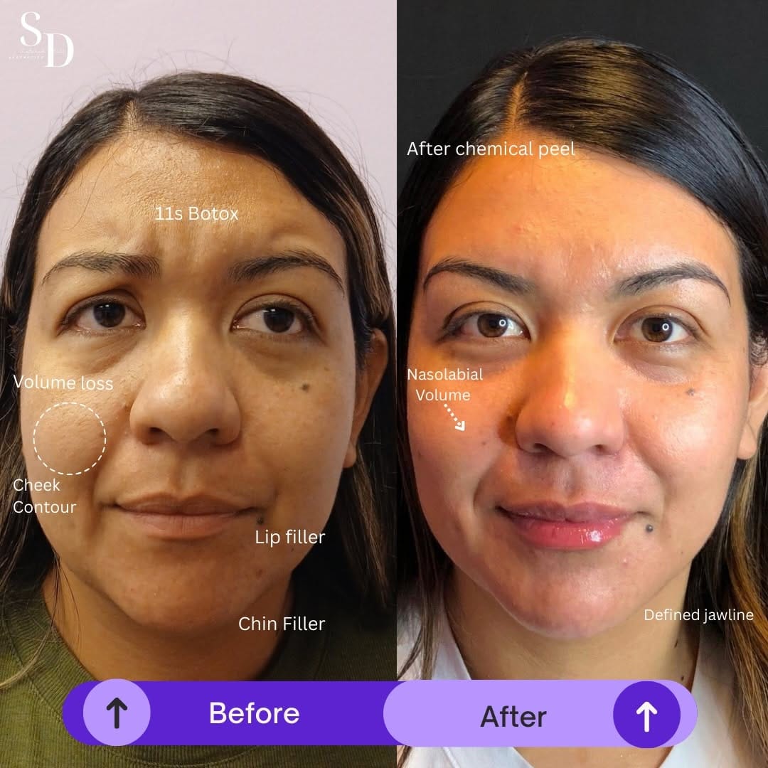 Post 7 by Botox. Fillers. Laser hair removal. Microneedling. PRP on Instagram (image)