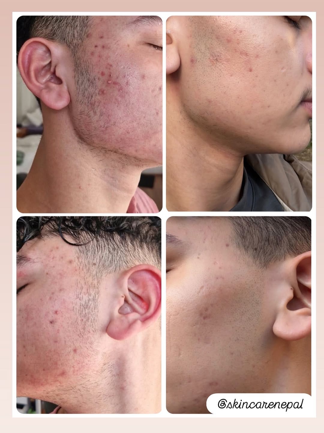 Post 2 by Skincare Nepal on Instagram (carousel)