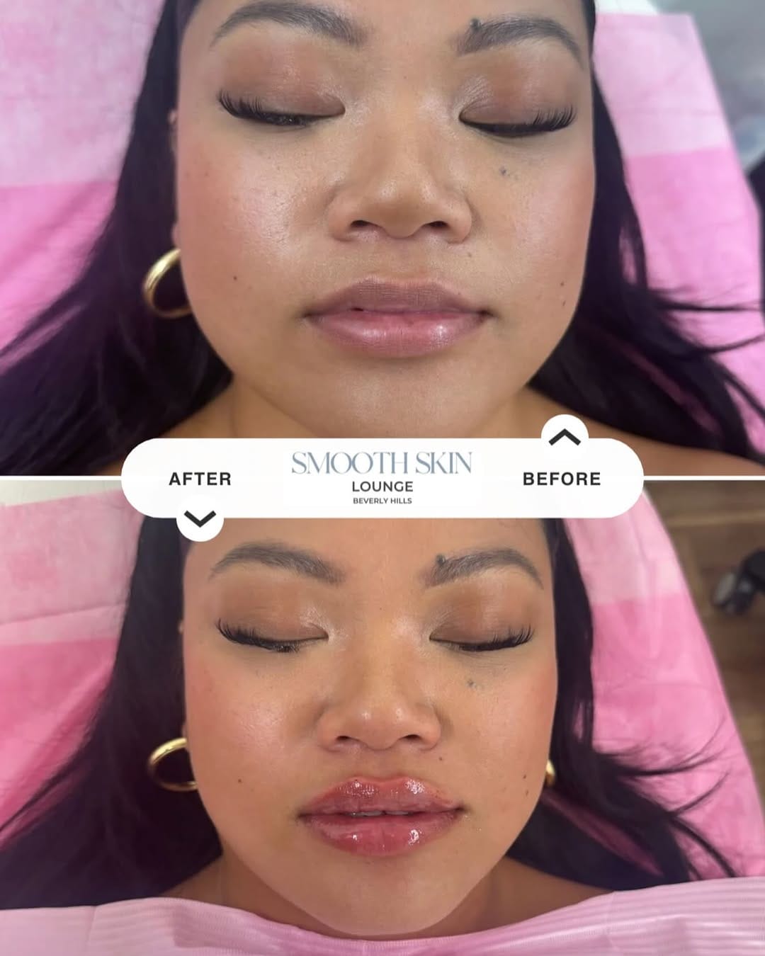 Post 3 by Smooth Skin Lounge | MedSpa on Instagram (image)
