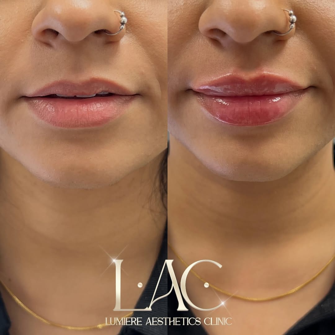 Post 3 by LIP FILLER LONDON 💉 📍MARYLEBONE on Instagram (carousel)