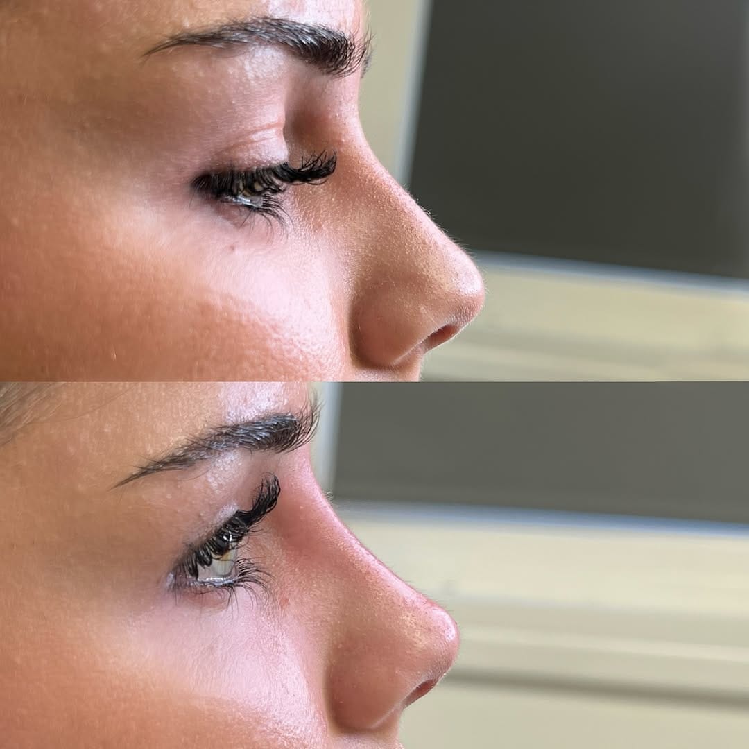 Post 6 by LIP FILLER LONDON 💉 📍MARYLEBONE on Instagram (image)