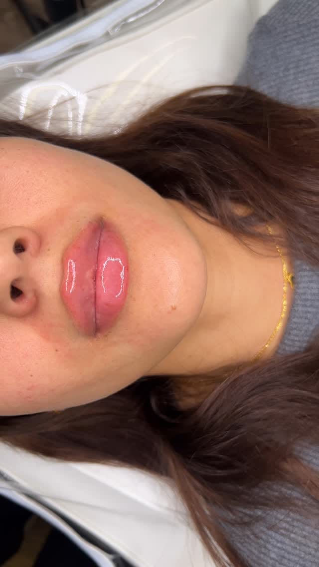 Post 8 by LIP FILLER LONDON 💉 📍MARYLEBONE on Instagram (video)
