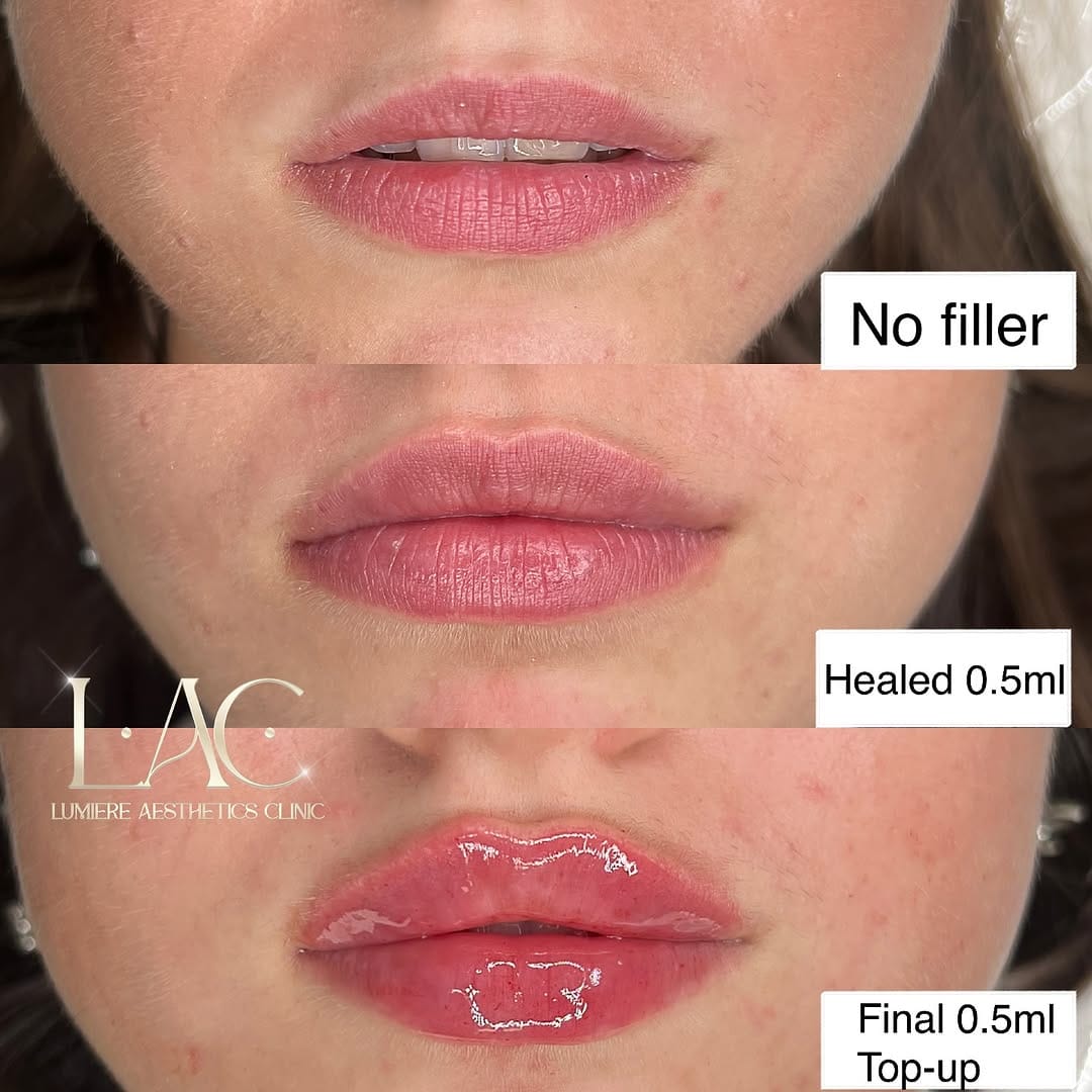 Post 7 by LIP FILLER LONDON 💉 📍MARYLEBONE on Instagram (image)