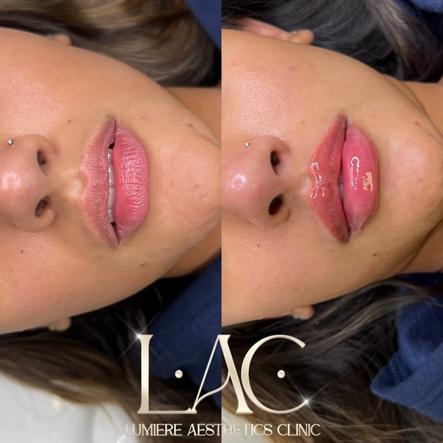 Post 2 by LIP FILLER LONDON 💉 📍MARYLEBONE on Instagram (image)