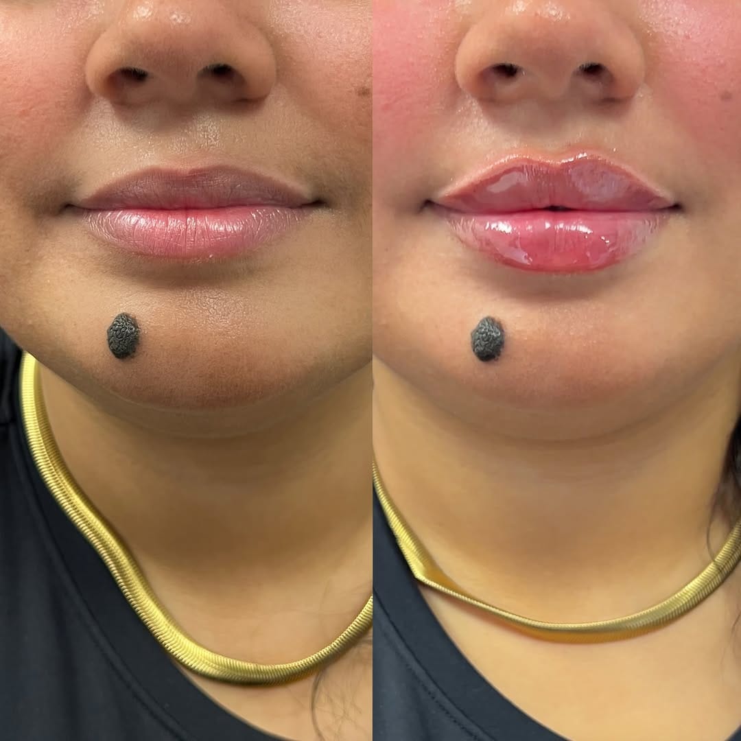 Post 1 by LIP FILLER LONDON 💉 📍MARYLEBONE on Instagram (carousel)