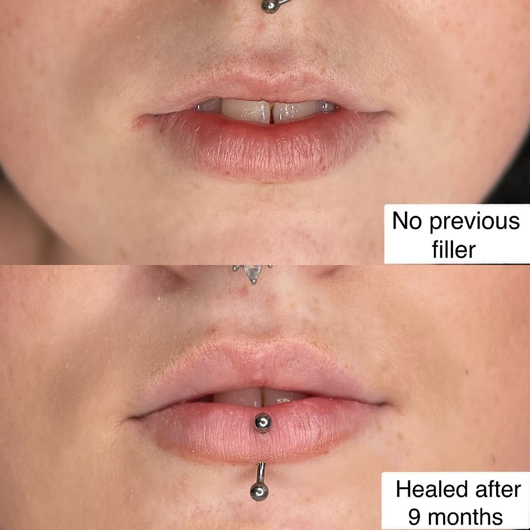 Post 5 by LIP FILLER LONDON 💉 📍MARYLEBONE on Instagram (image)