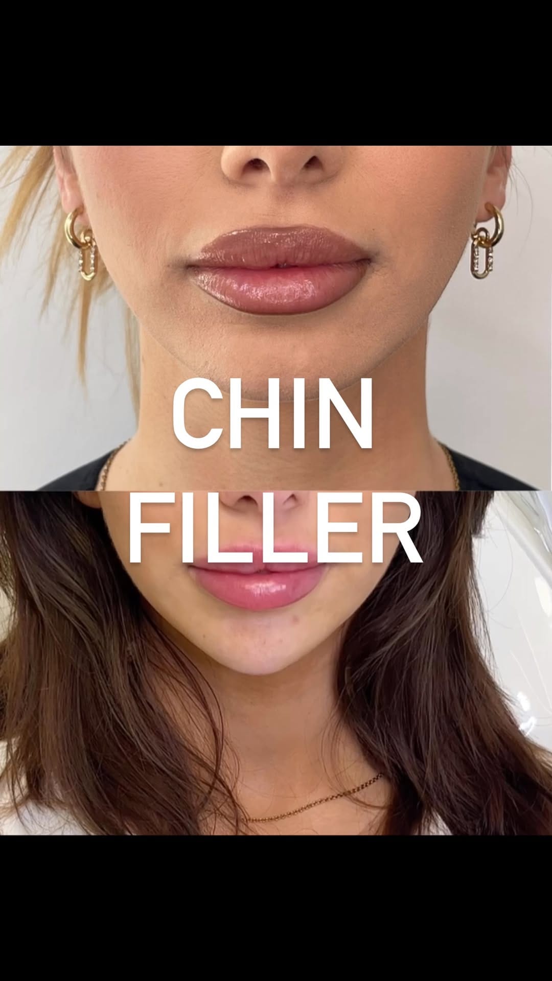 Post 9 by LIP FILLER LONDON 💉 📍MARYLEBONE on Instagram (video)