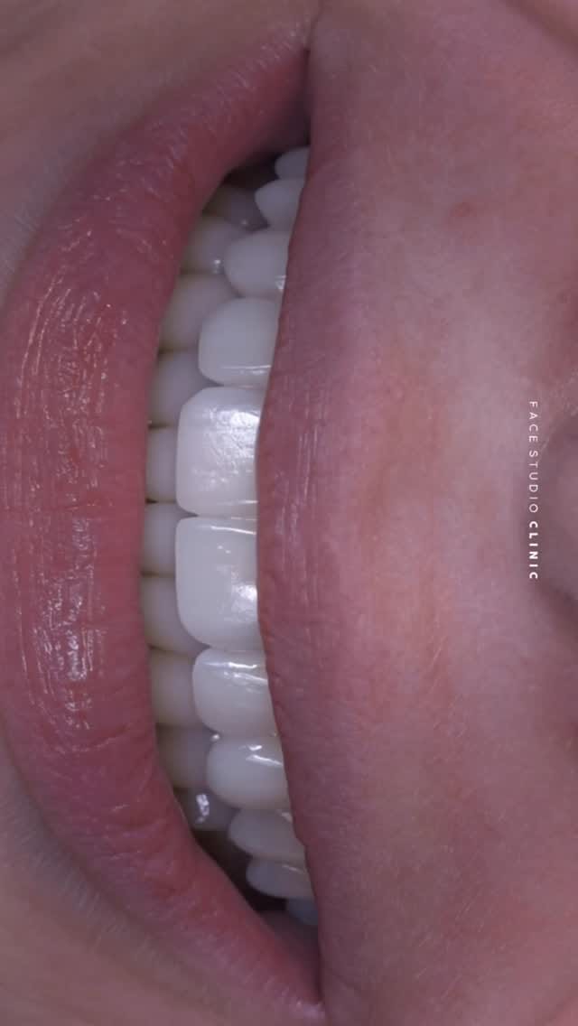 Post 6 by Face Studio Clinic | Skin, Dental & Aesthetics on Instagram (video)