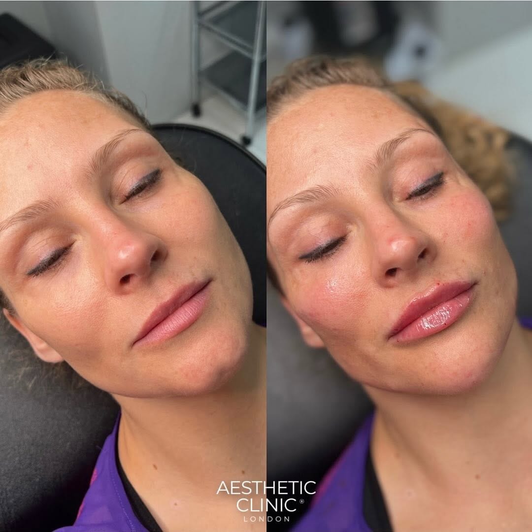 Post 10 by Nurse Nasrin  | Subtle natural results on Instagram (image)