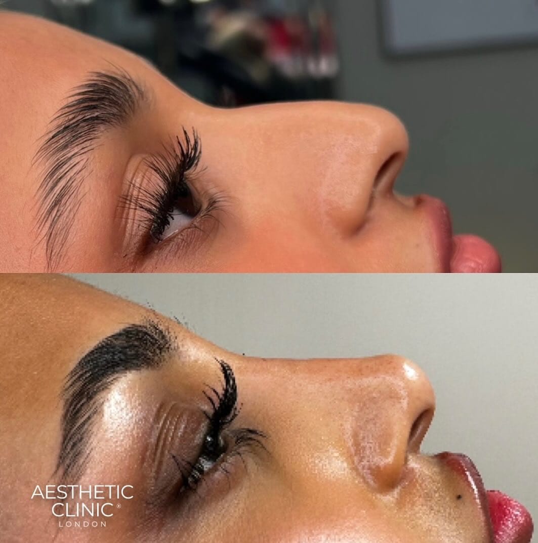 Post 9 by Nurse Nasrin  | Subtle natural results on Instagram (carousel)