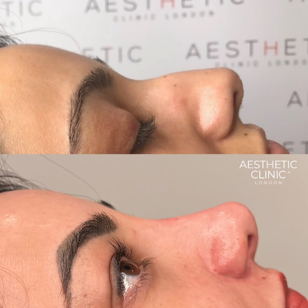 Post 4 by Nurse Nasrin  | Subtle natural results on Instagram (image)