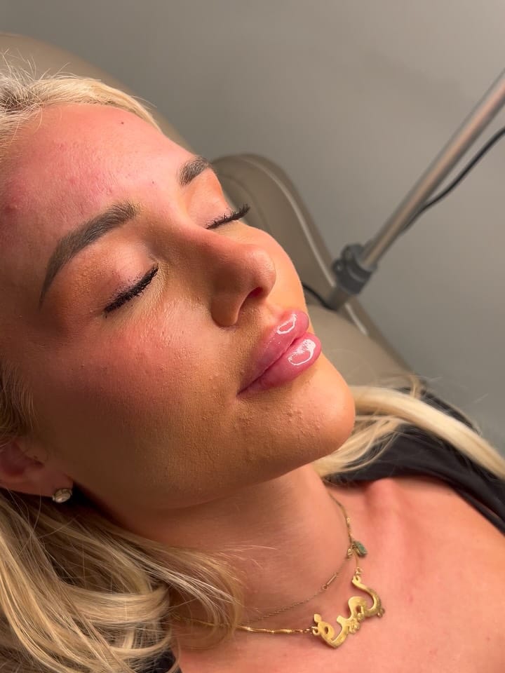 Post 2 by Nurse Nasrin  | Subtle natural results on Instagram (carousel)