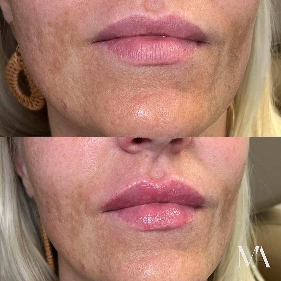 Post 5 by 𝐍𝐢𝐜𝐨𝐥𝐞 𝐊𝐚𝐬𝐬𝐚𝐛, Nurse Injector on Instagram (image)