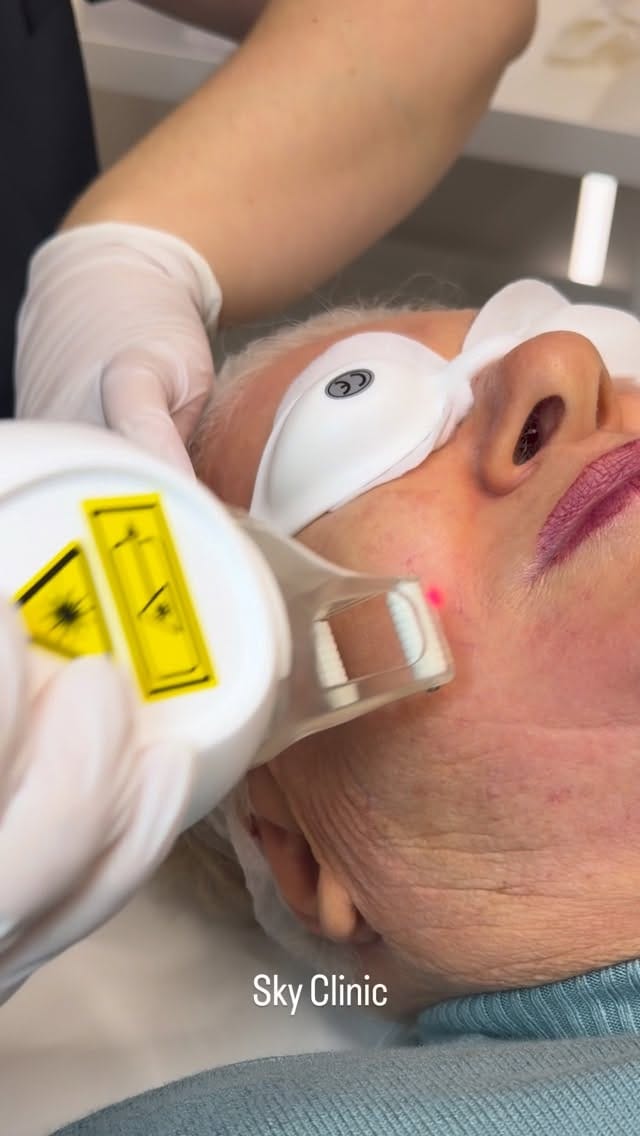 Post 3 by Sky Clinic UK on Instagram (video)