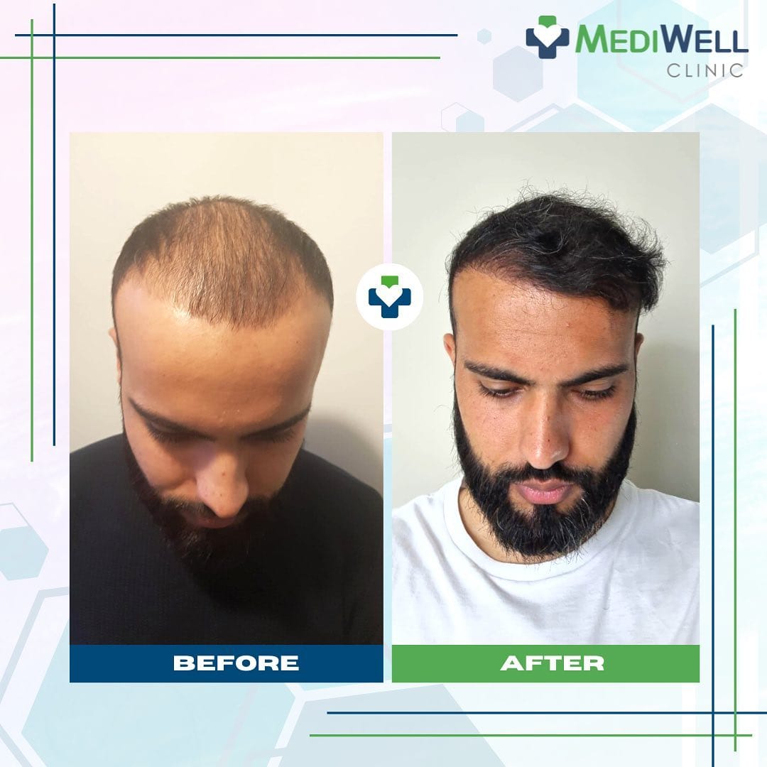 Post 9 by MediWell Hair Clinic on Instagram (image)