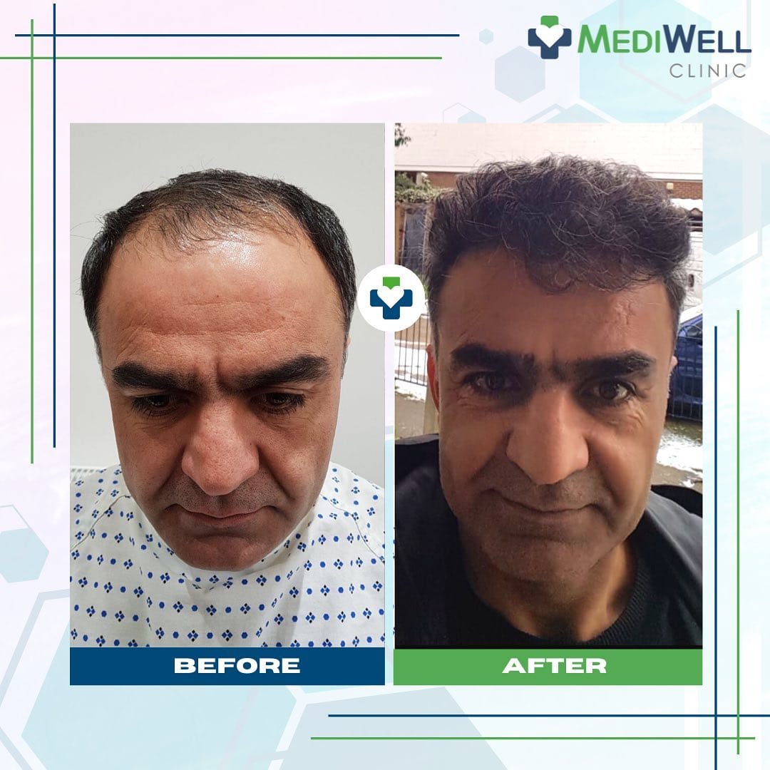 Post 10 by MediWell Hair Clinic on Instagram (image)