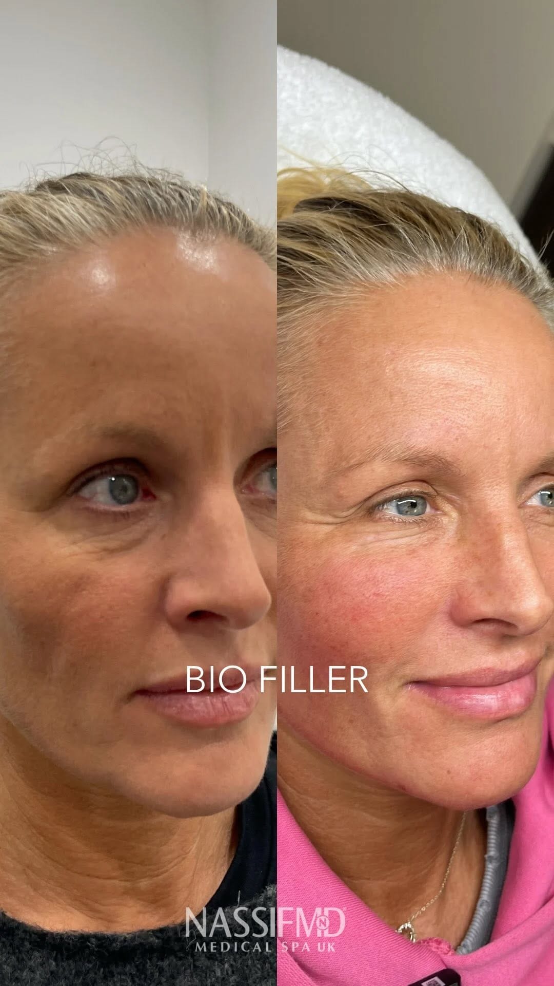 Post 10 by Nassif Medical Spa™ UK on Instagram (video)