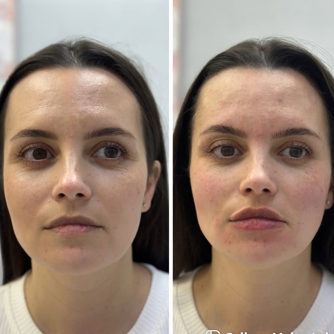 Post 9 by Dr dermatologist aesthetic practitioner London on Instagram (carousel)