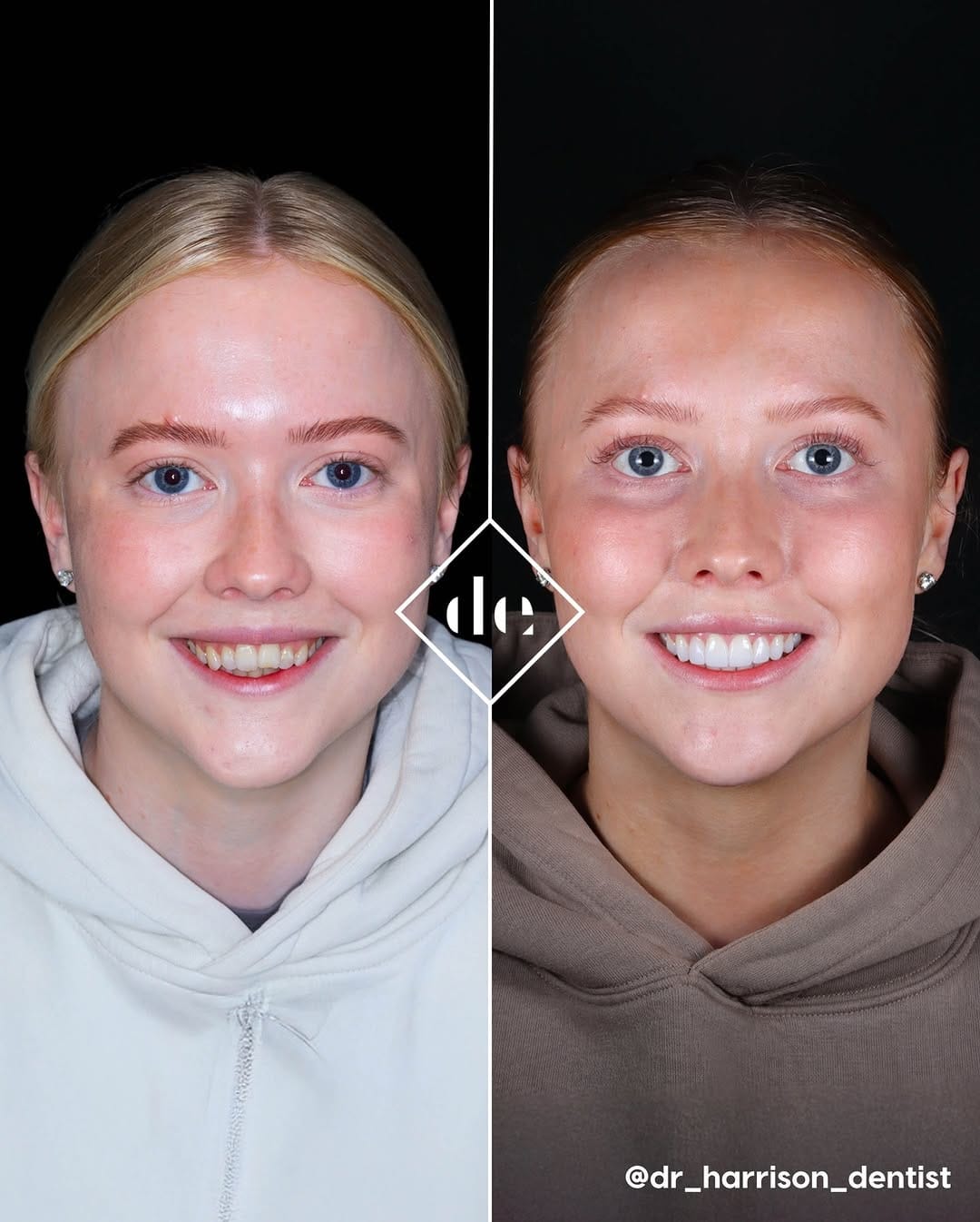 Post 5 by Dental Excellence UK on Instagram (carousel)