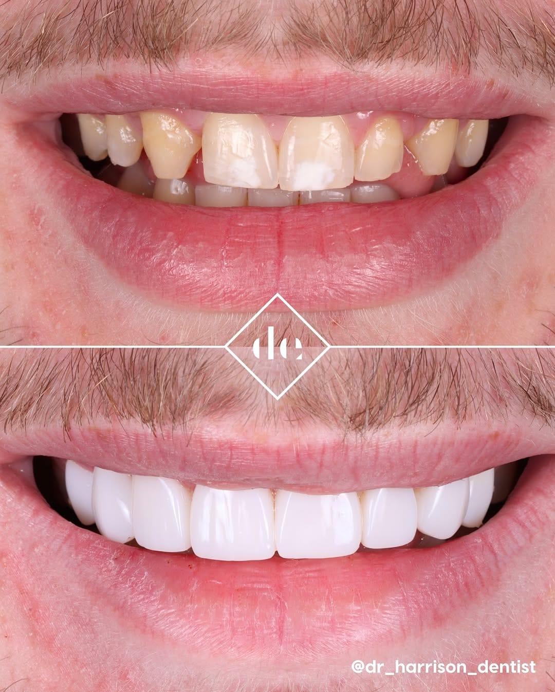 Post 6 by Dental Excellence UK on Instagram (carousel)