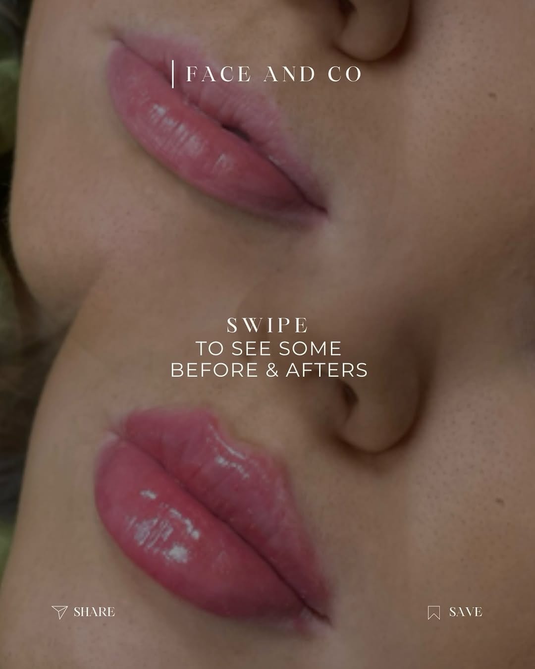Post 4 by Face and Co Advanced Injectables on Instagram (carousel)