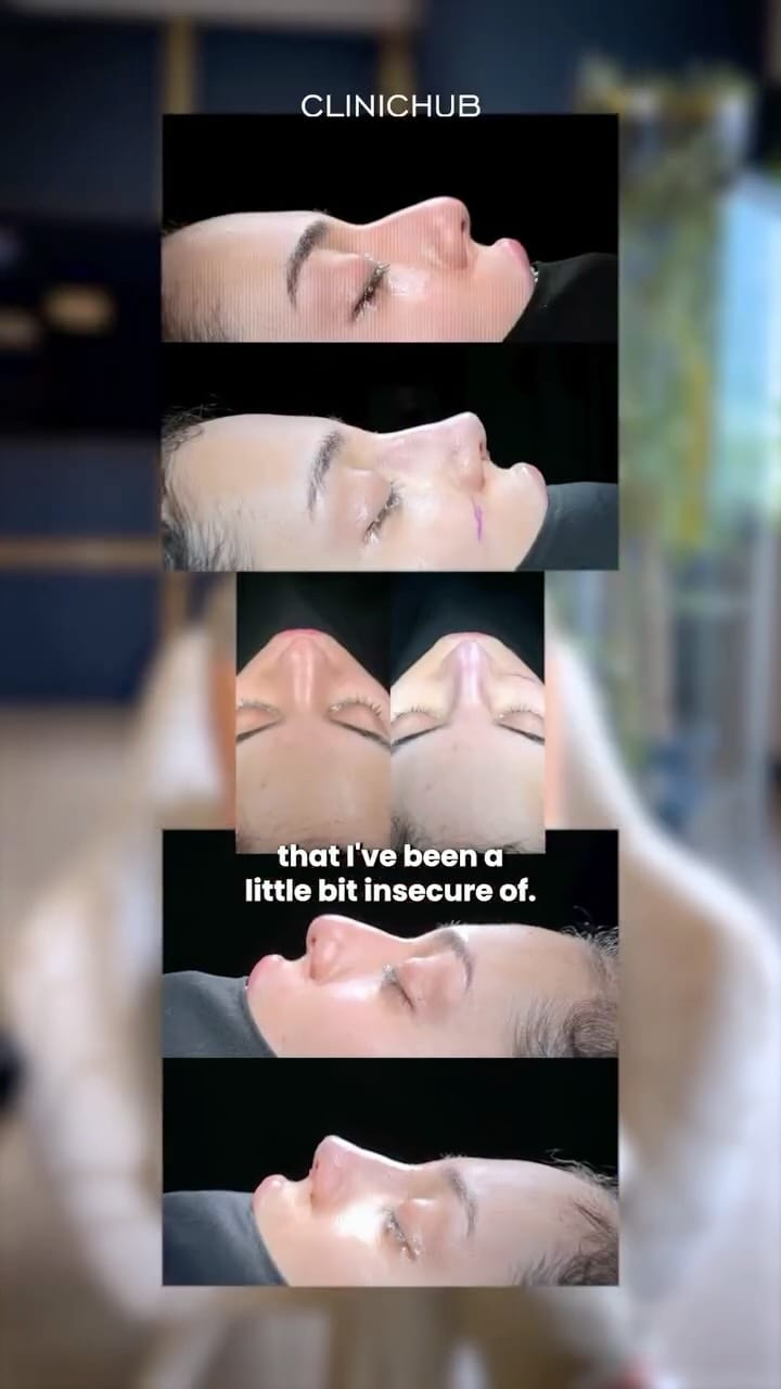 Post 3 by Clinichub Cosmetic Surgery on Instagram (video)