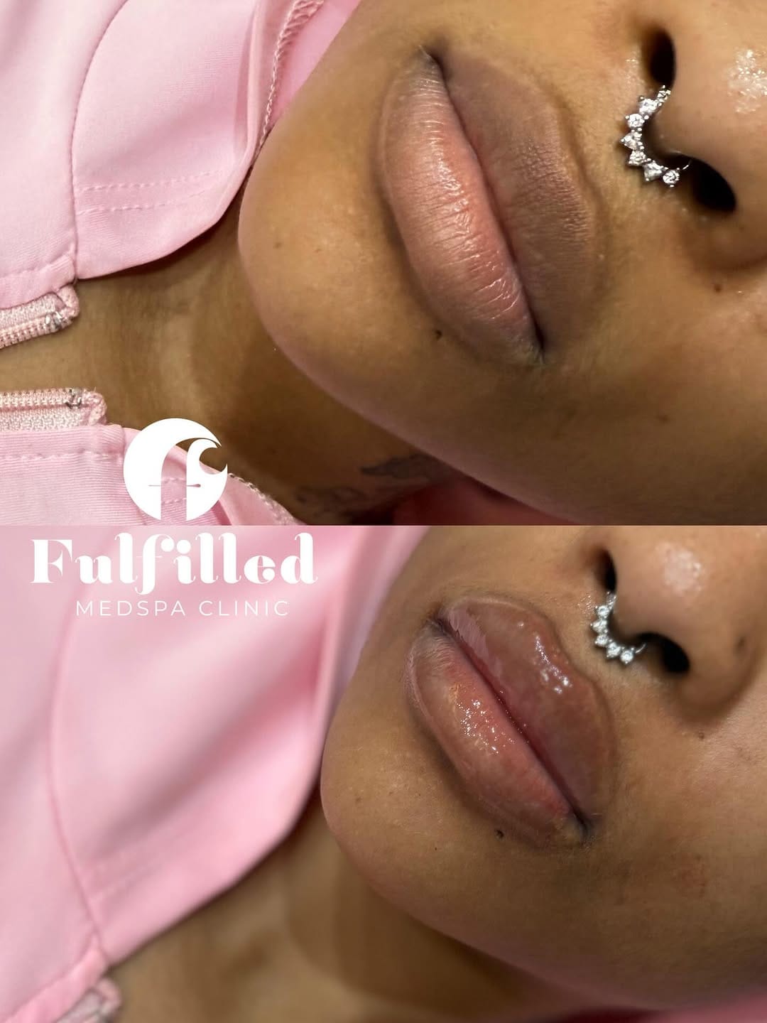 Post 9 by Fulfilled Medspa Clinic on Instagram (image)