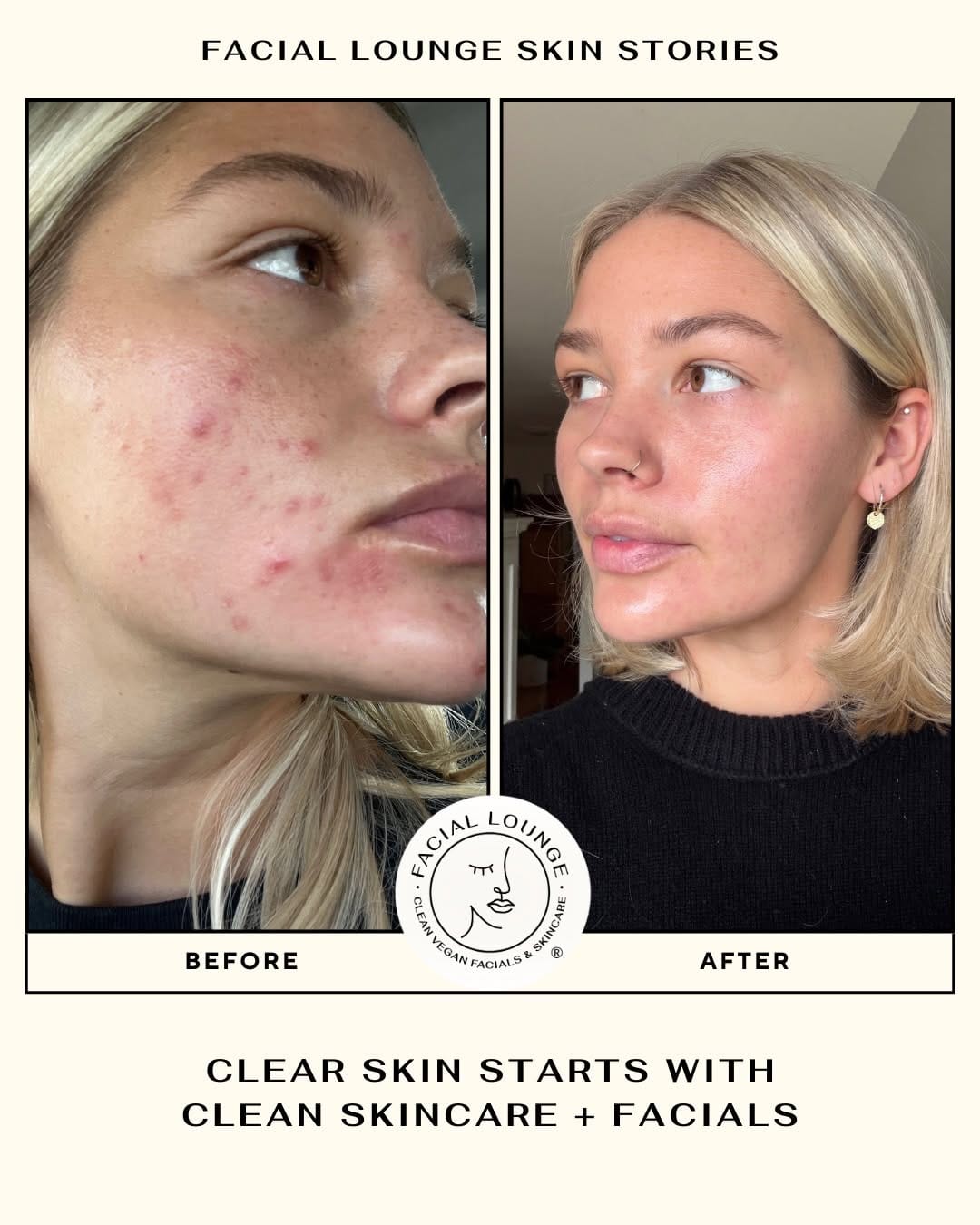 Post 10 by Facial Lounge Newport Beach and Costa Mesa on Instagram (carousel)