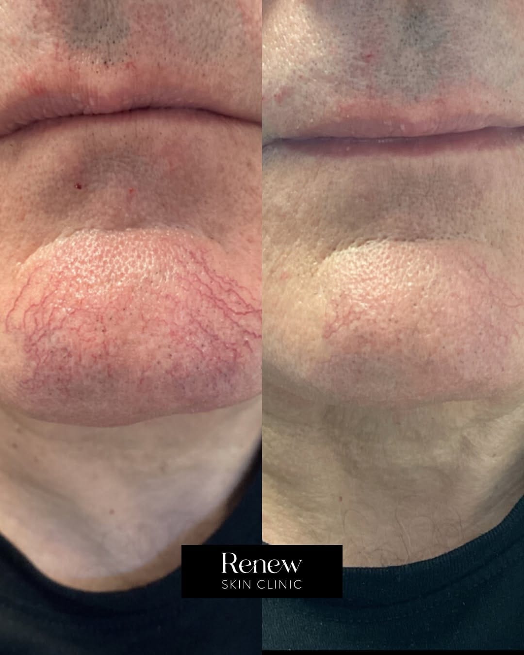 Post 4 by Renew Skin Clinic | Skincare Experts on Instagram (carousel)