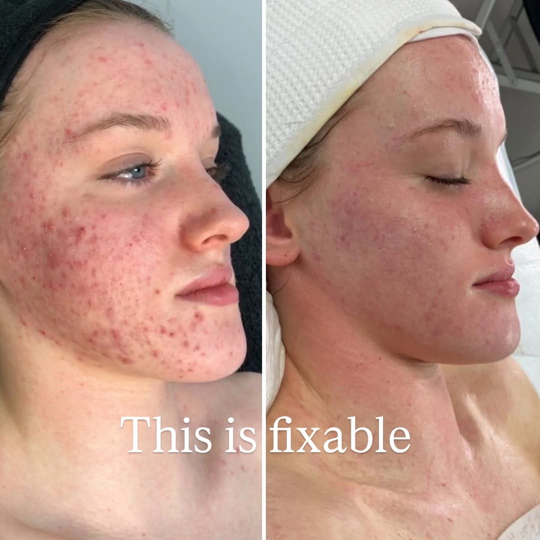 Post 9 by Skin Clinic | Ageing & Acne Specialist N. Ireland on Instagram (carousel)