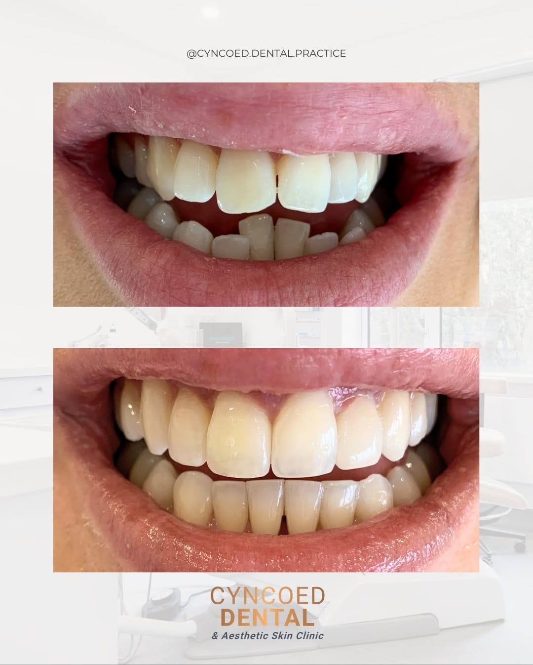 Post 2 by Dr Zena Invisalign Dentist & Aesthetics Cardiff on Instagram (carousel)