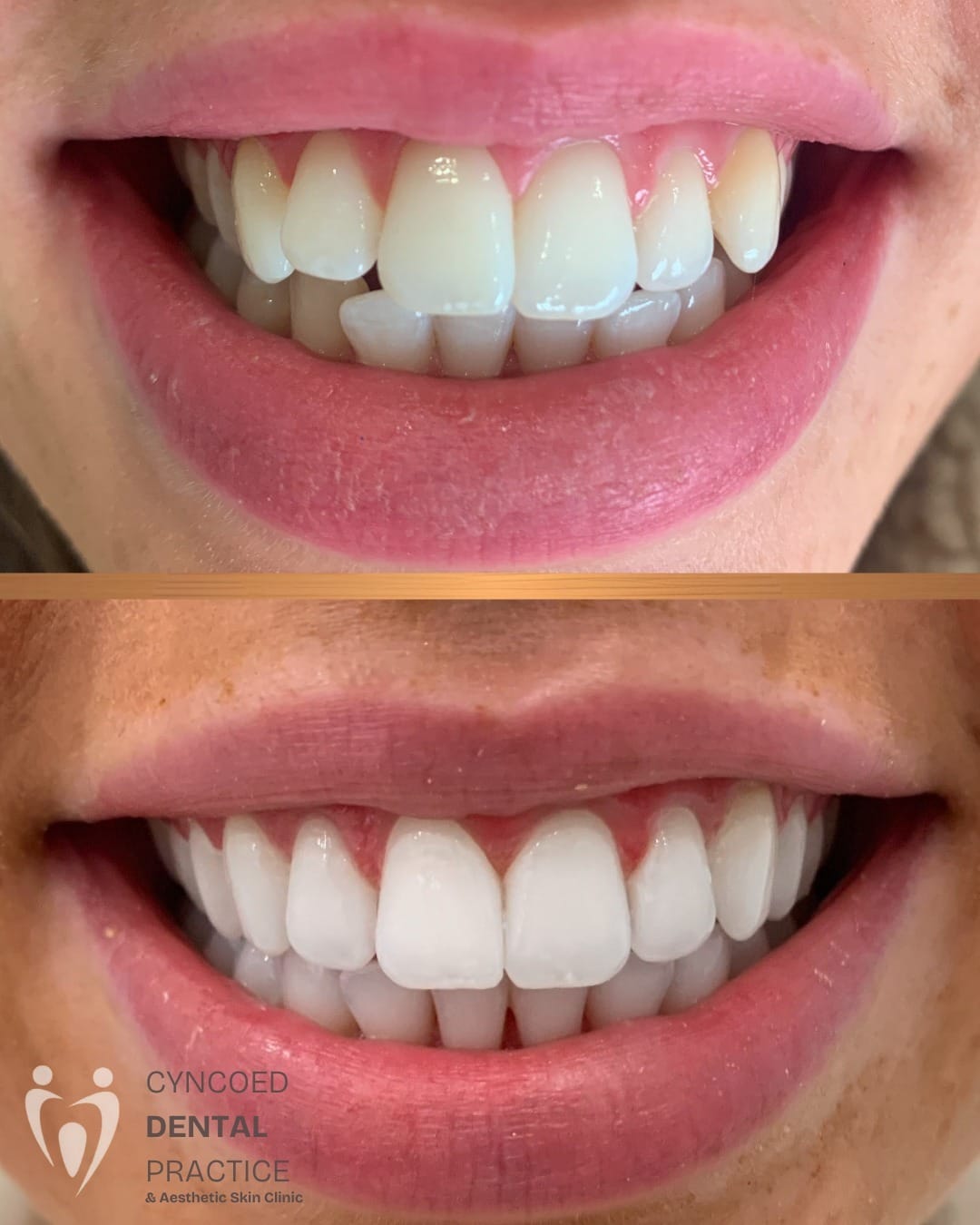 Post 9 by Dr Zena Invisalign Dentist & Aesthetics Cardiff on Instagram (carousel)