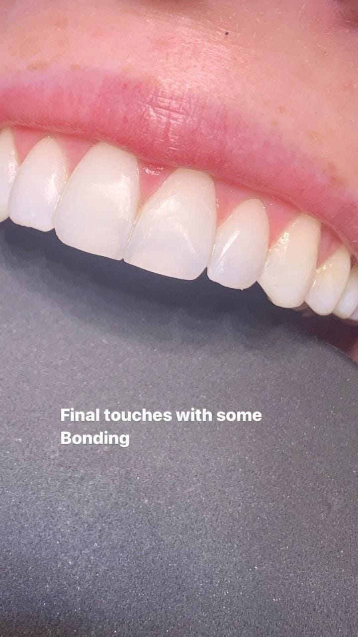 Post 10 by Dr Zena Invisalign Dentist & Aesthetics Cardiff on Instagram (video)