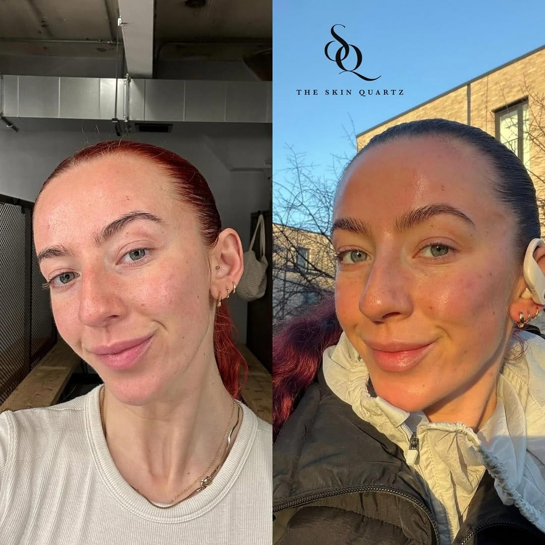Post 3 by Skin Quartz Laser & Skin Clinic Manchester ™️ on Instagram (image)