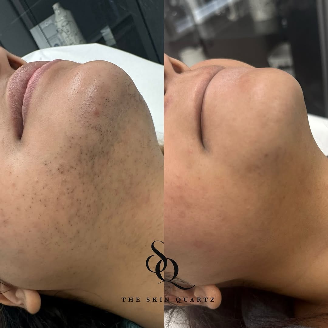 Post 10 by Skin Quartz Laser & Skin Clinic Manchester ™️ on Instagram (image)