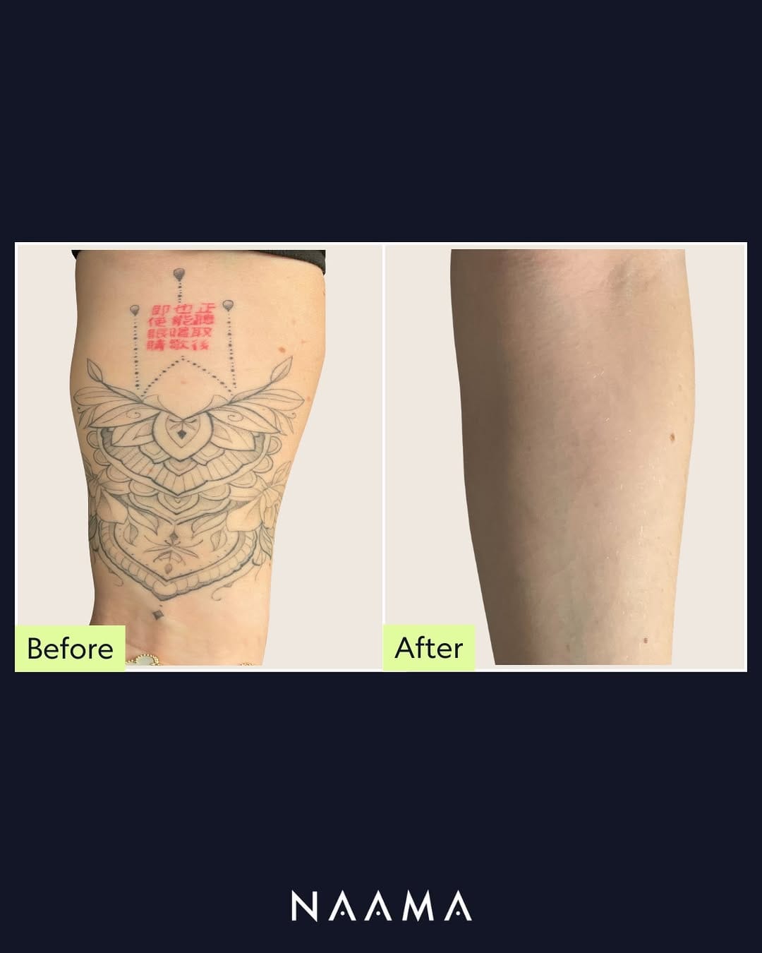 Post 1 by NAAMA Studios Laser Tattoo Removal on Instagram (image)