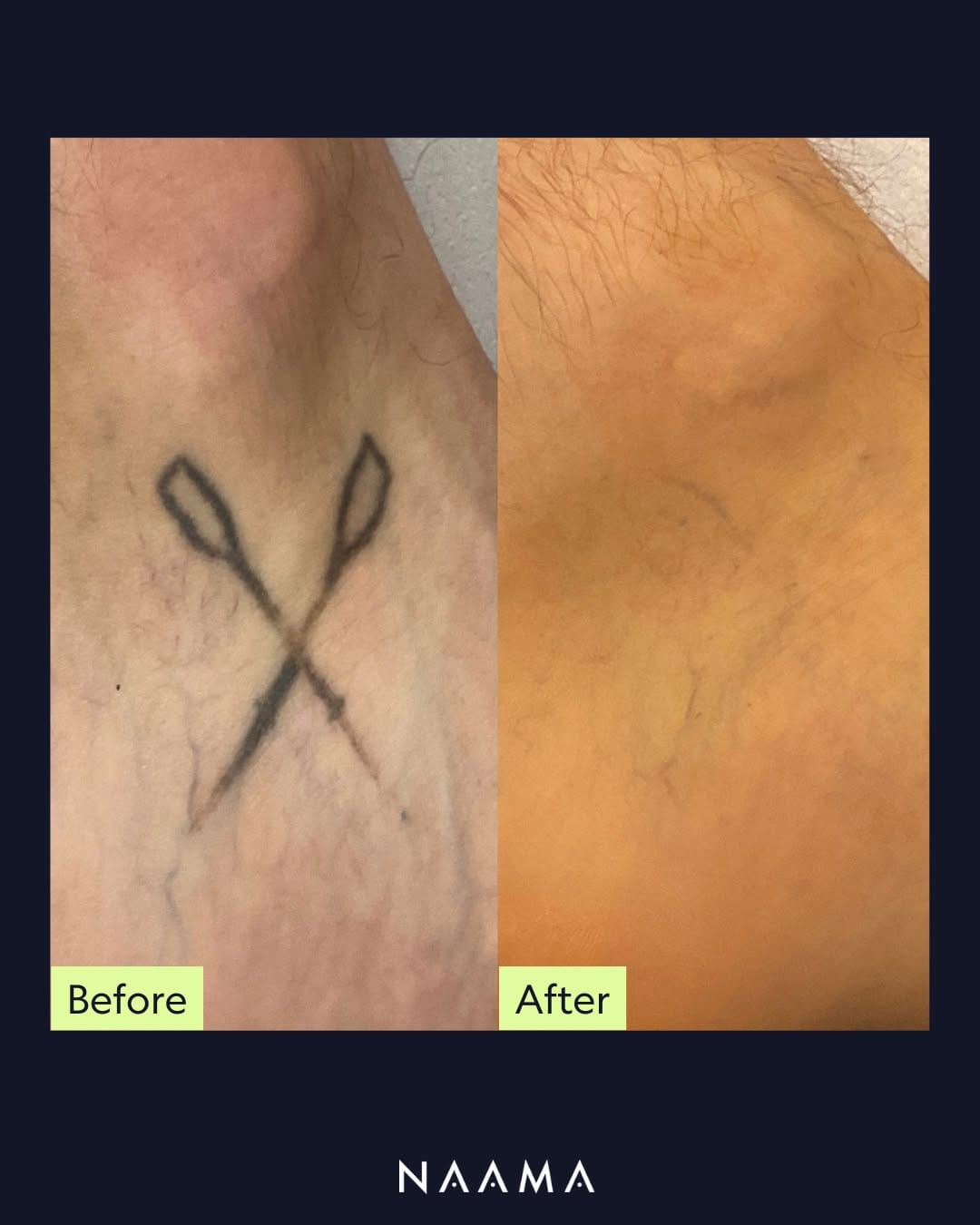 Post 7 by NAAMA Studios Laser Tattoo Removal on Instagram (image)