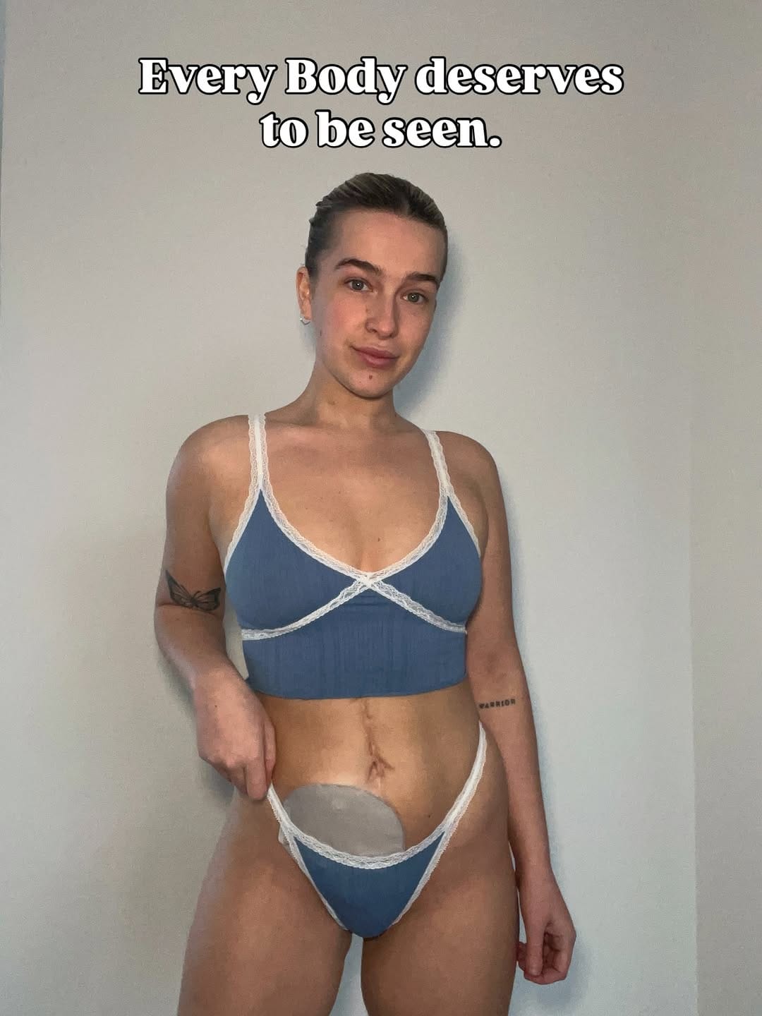 Post 6 by Phillipa | IBD & OSTOMY ♡︎ on Instagram (image)