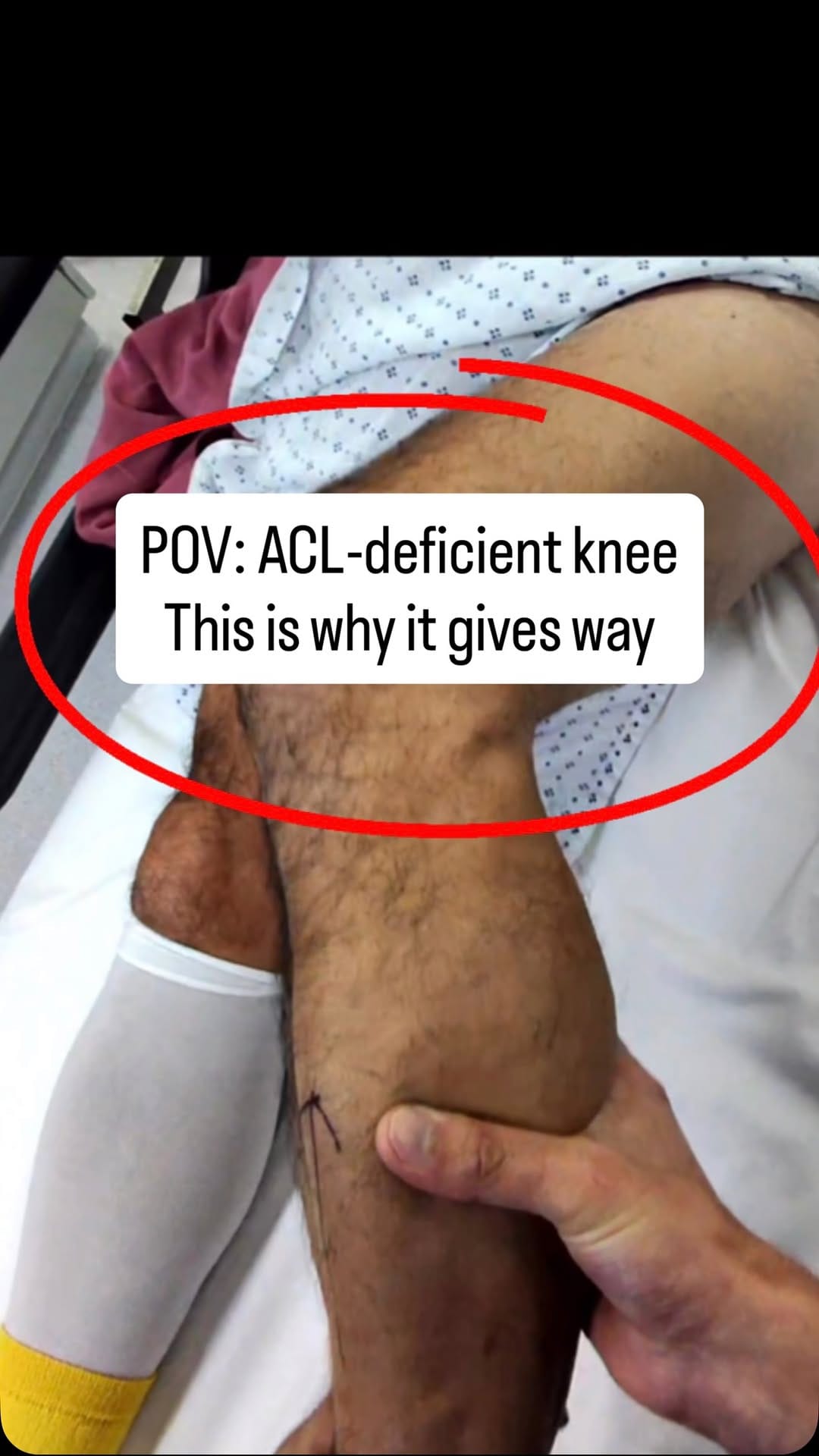 Post 8 by Dr Kash Akhtar | ACL, Meniscus, Cartilage on Instagram (video)