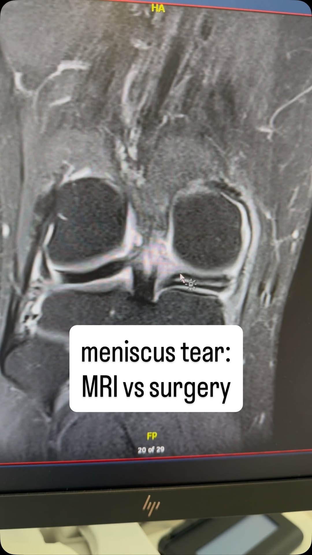 Post 4 by Dr Kash Akhtar | ACL, Meniscus, Cartilage on Instagram (video)
