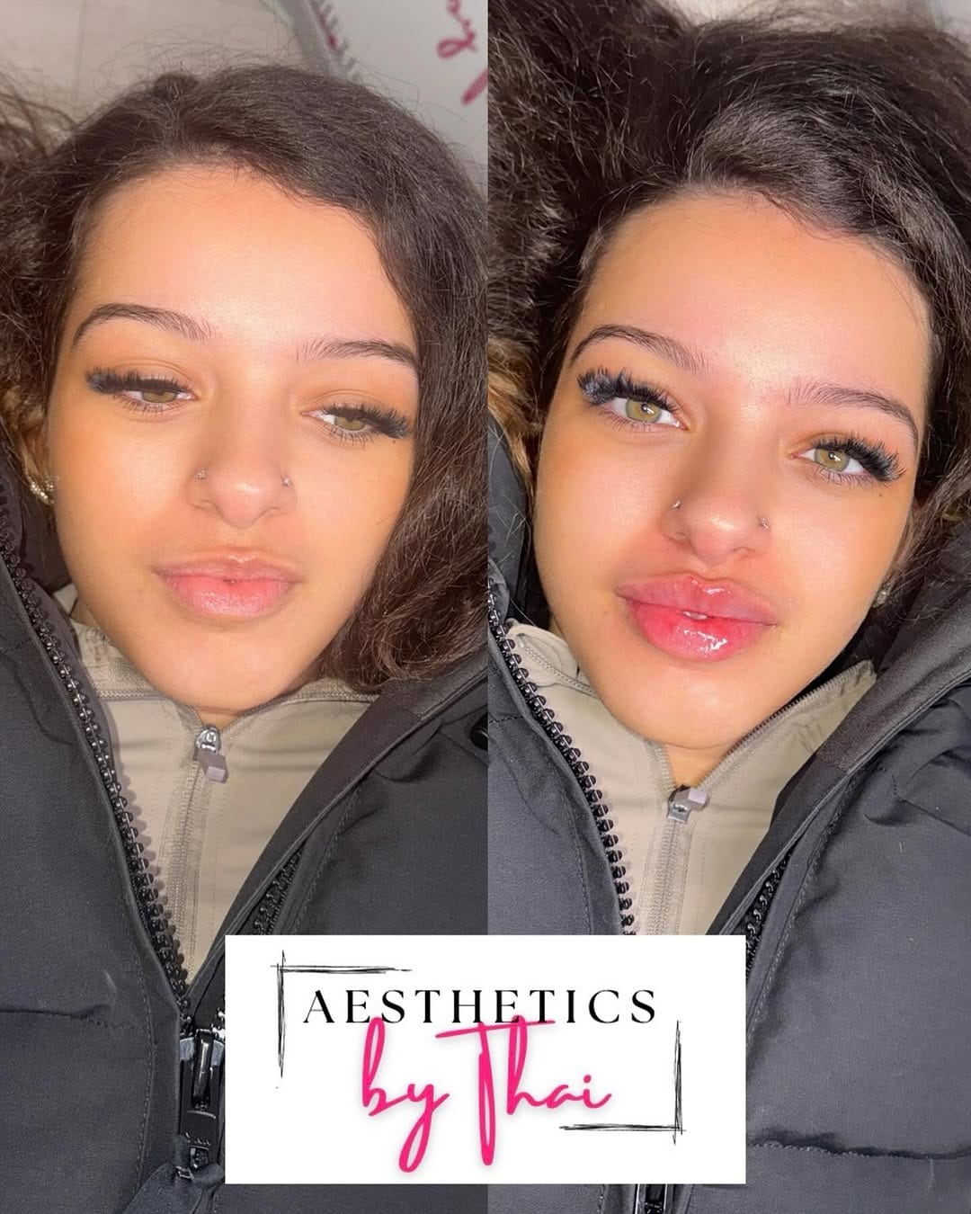 Post 10 by LIP FILLER | RUSSIAN LIPS | FILLERS | Aesthetics London on Instagram (image)