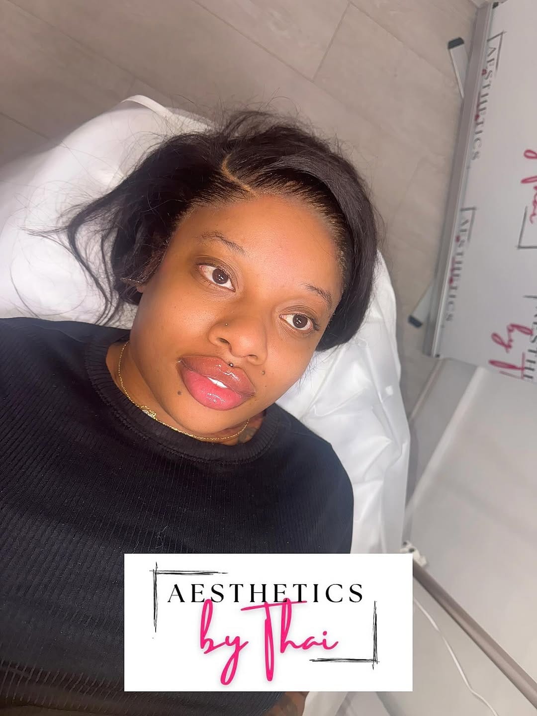 Post 3 by LIP FILLER | RUSSIAN LIPS | FILLERS | Aesthetics London on Instagram (image)