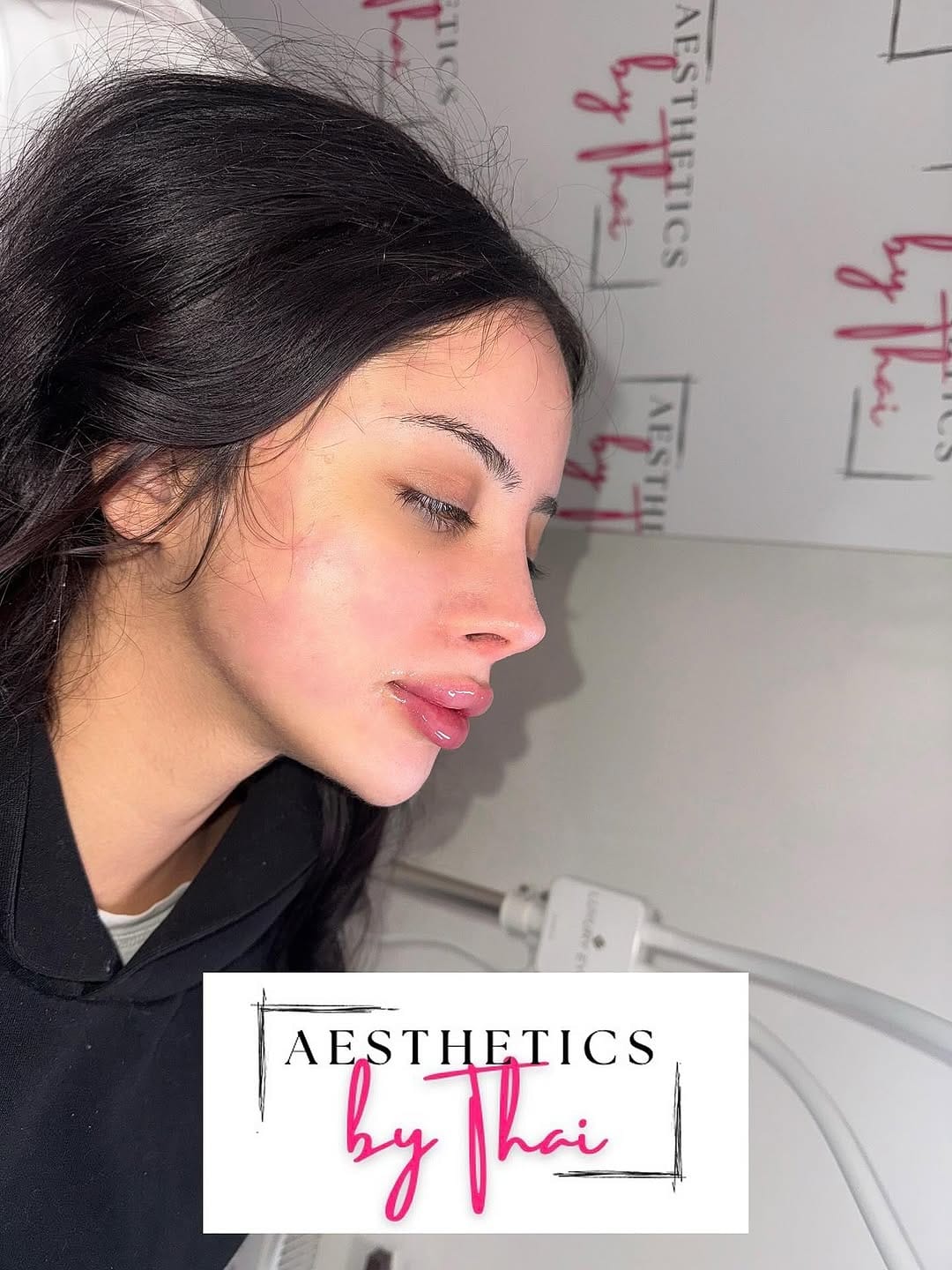 Post 6 by LIP FILLER | RUSSIAN LIPS | FILLERS | Aesthetics London on Instagram (image)