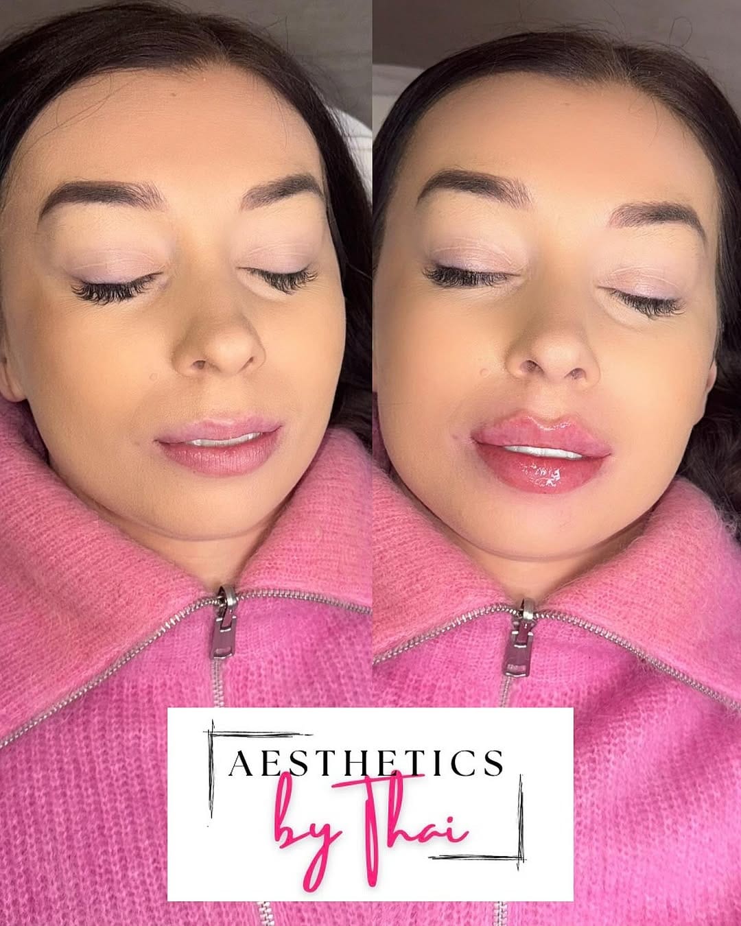 Post 2 by LIP FILLER | RUSSIAN LIPS | FILLERS | Aesthetics London on Instagram (image)